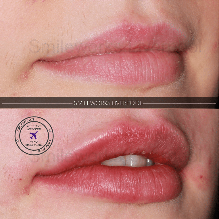 Lip fillers Liverpool Get seen quickly. Top grade products. 50 off!