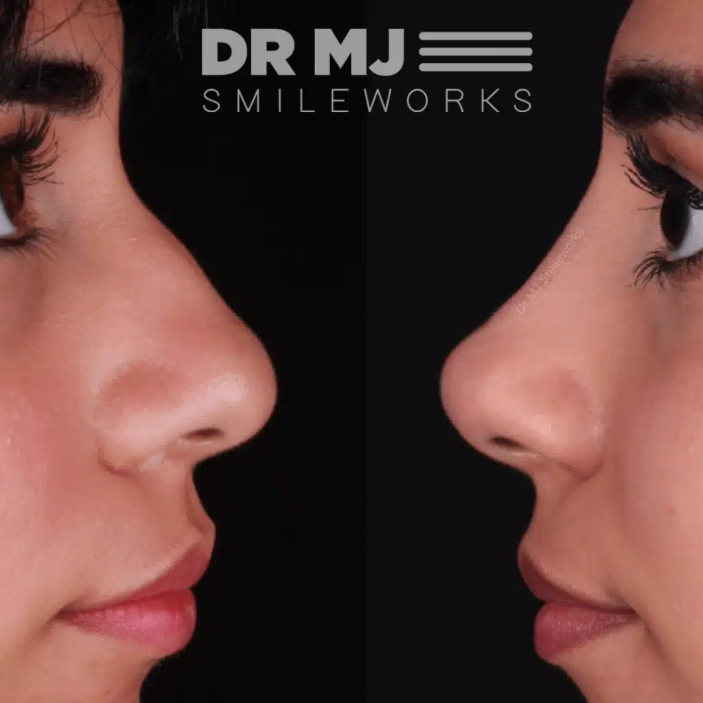 non-surgical rhinoplasty before and after