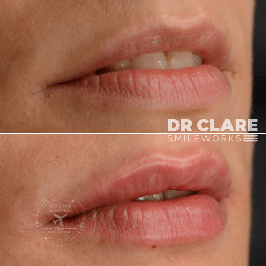 Lip Filler Liverpool Save £240 as a HUB Model!