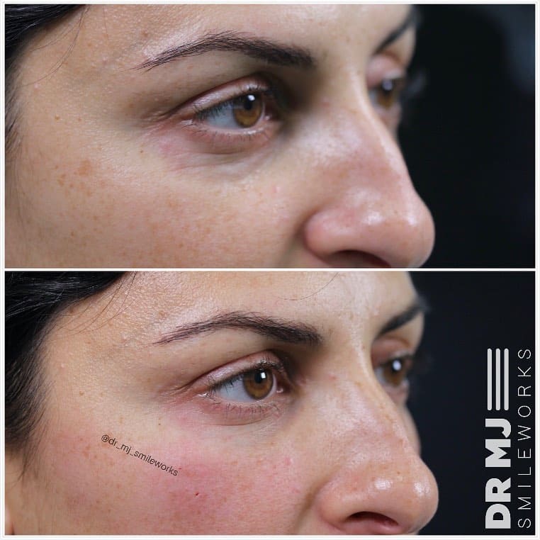 tear trough filler before and after