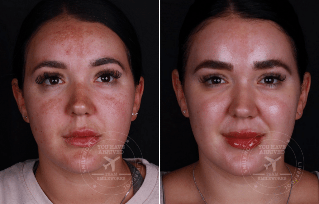 laser skin resurfacing before and after