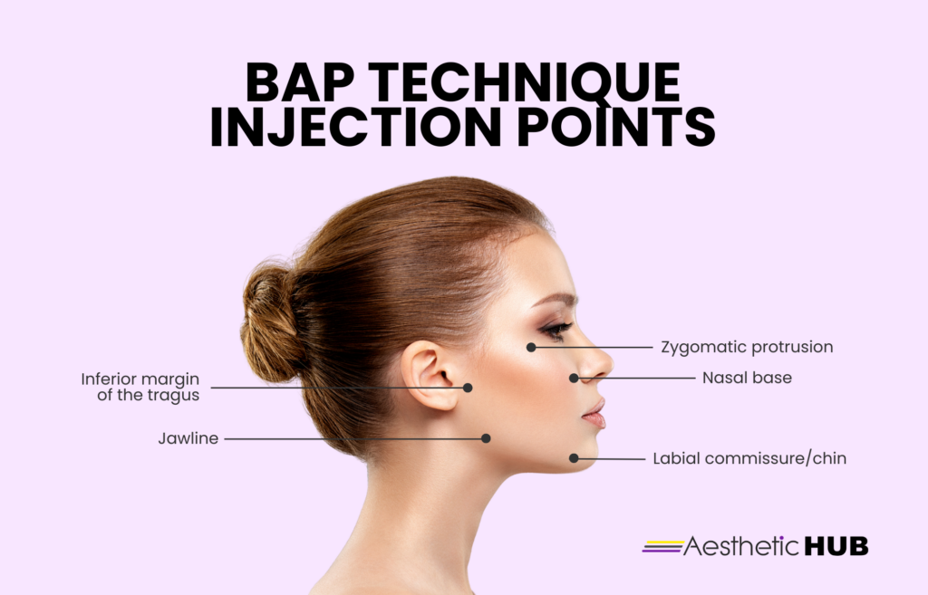 skin booster injection points