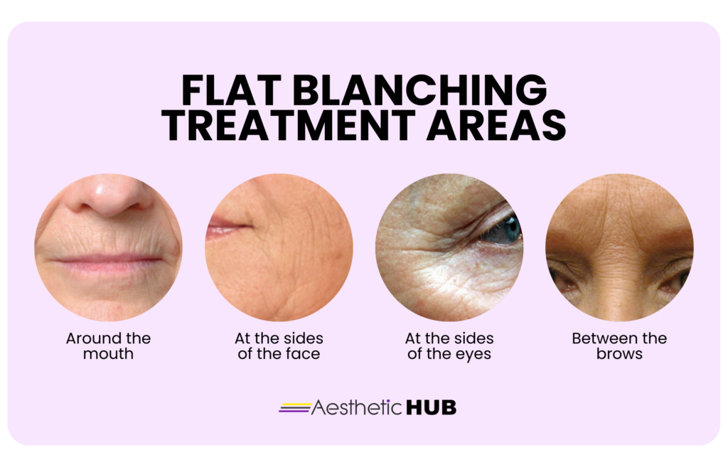 skin booster treatment areas