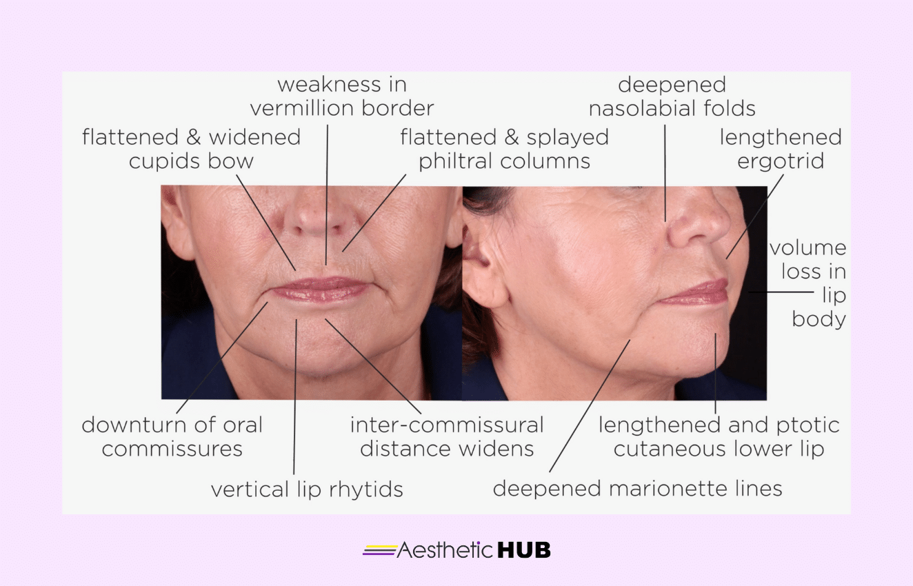 What Causes the Thinning of Lips? Insights from an Expert