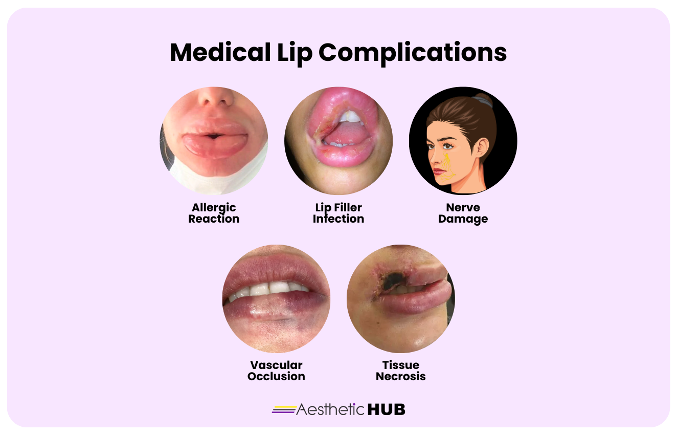 8-signs-of-lip-fillers-gone-wrong-and-how-to-prevent-it