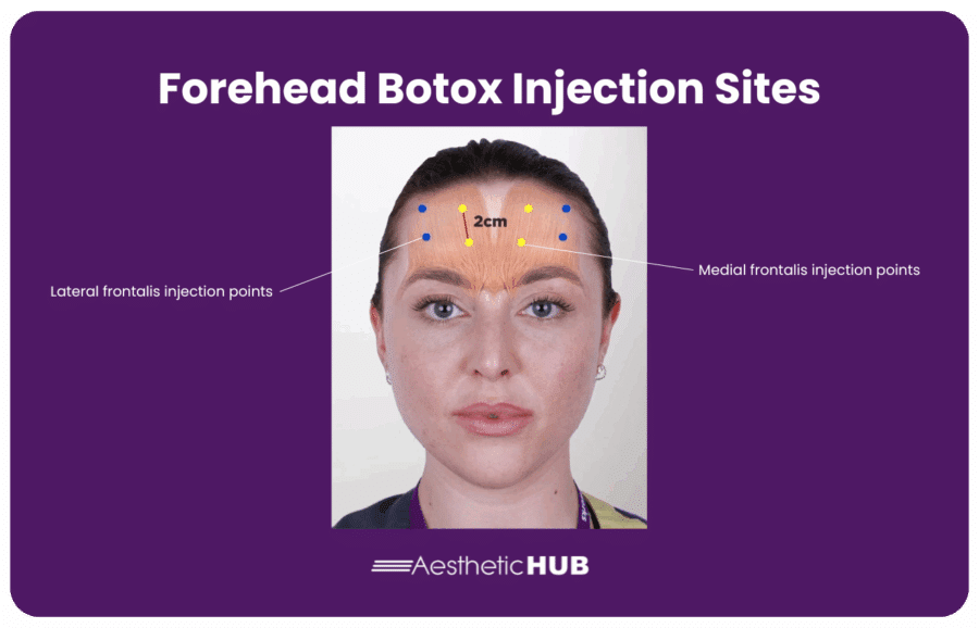 Master Botox Forehead Injection Sites: Expert Techniques