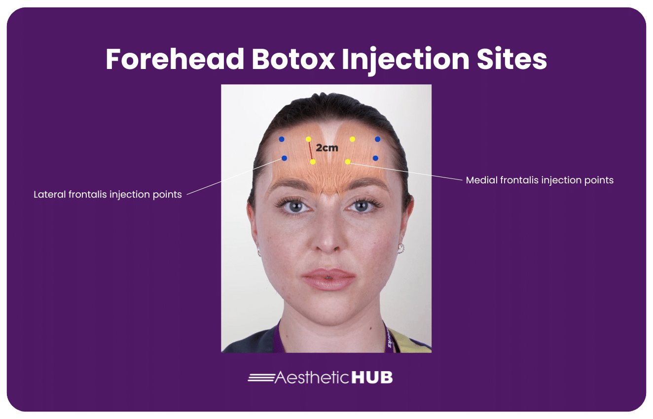 Master Botox Forehead Injection Sites: Expert Techniques